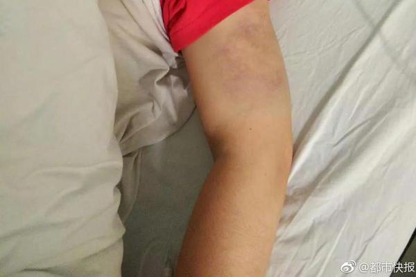 Researchers found a potential link between daily walking and reduced risk of type 2 diabetes